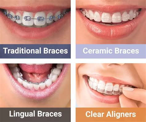 metal brackets vs ceramic|are ceramic braces more expensive.